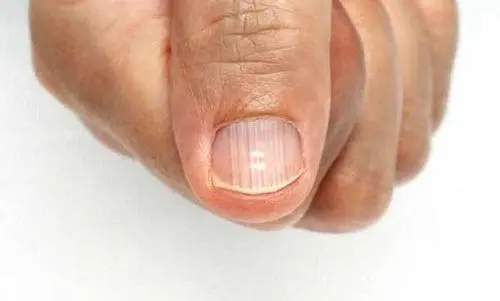 指甲有竖纹是身体的什么信号，指甲上有竖纹，怎么回事？