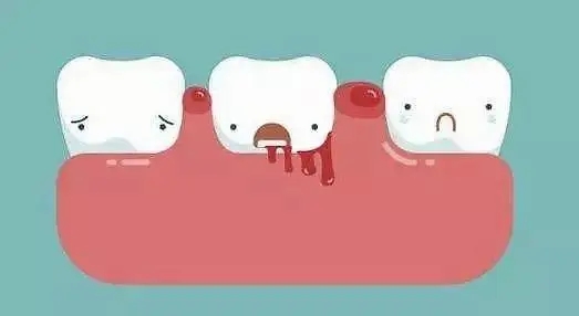 牙龈出血是怎么回事？（牙龈出血的原因是什么）